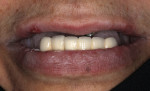 Pretreatment smile photograph showing the supraeruption of the patient’s mandibular anterior teeth.