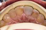 A template of the new smile design against the existing dentition reveals the additive approach that will be used.