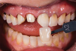 A series of burs (KS1 Diamond, Brasseler; ET6 Carbide, Brasseler) was used to remove the composite restorations while maintaining the structural integrity of the teeth. The natural color of the maxillary teeth is the same as the opposing teeth because no additional tooth structure was removed.