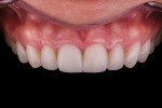 Floss indentation was used to evaluate and verify the esthetics of the tissue levels.