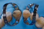 Rubber dam isolation (Dental Dam, Nic Tone; HYGENIC® Brinker Clamps, Coltene) was achieved for the insertion of two restorations at a time.