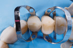 Protecting the adjacent teeth from the etching (Select HV® Etch, BISCO) and bonding (Adhese® Universal VivaPen, Ivoclar Vivadent) protocol was accomplished with Tofflemire matrix bands (HO Bands™, HO Dental Company), but PTFE tape can also be used.