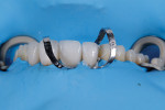 Each time that two restorations (Amber® Press, HASS BIO America) were seated, all of the excess cement (Variolink® Esthetic [Neutral], Ivoclar Vivadent) was removed, and the next pair of restorations was tried in to verify complete seating.