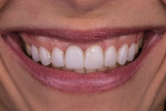 Posttreatment smile photograph of the porcelain restorations achieving a more natural smile curve and fuller buccal corridors.