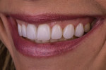 In this posttreatment left lateral photograph, the amount of buccal volume added can be visualized by the difference between tooth No. 13, which is untreated, and tooth No. 12, which has the veneer.