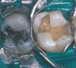 The first molar is prepared, bonded, and the matrix is placed.