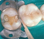 The second molar is prepared, bonded, and the matrix is placed.