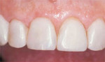 Composite veneers with improved tooth shape, position, and color.