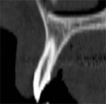 The cross-sectional image of a central incisor.