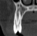 A premolar tooth with similar findings of minimal existing bone thickness surrounding the roots.