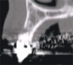 Cross-sectional slice number 49 depicts the severe resorption of the natural tooth root.
