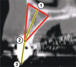 The ideal placement within the most volume of bone should bisect the triangle, as shown by the yellow line connecting points 1 and 2.