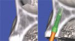 The implant is seen within the bony housing placed within the TOB