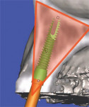 The 3-dimensional reconstructed view of a virtual implant and abutment, with an overlay of the TOB, can be seen.