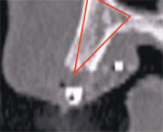The TOB (seen in red) is created in the cross-sectional view to assess and then confirm the volume of bone.