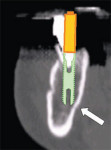 The tooth was hopeless and facial to its normal position and the implant was planned to be placed in an ideal position. Note the lingual concavity that cannot be detected with conventional panoramic or periapical radiography.