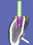 Using 3-dimensional reconstruction, a wider, shorter, realistic, and simulated implant was placed in adequate bone to avoid potential problems.