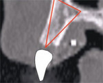 A barium sulfate template is worn during the scanning process to incorporate the fully contoured opaque tooth image.