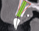 A line can be drawn from the incisal edge of the tooth to the midline of the implant to help determine the type of abutment that will be needed to properly restore the case. The abutment shape can then be developed by the software application to provide support for the clinical crown.