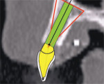 For this example, the custom-angulated abutment would be an acceptable 8 degrees off the centerline of the implant.
