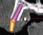 The ability to place realistic abutments will offer even more exact tools to aid in the diagnosis and treatment-planning phase.