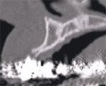 The cross-sectional image of a potential implant receptor site in the maxillary arch. Note that the thin alveolar crest and facial concavity are apparent in this view, but would not be obvious in a periapical radiograph.