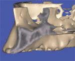 The 3-dimensional reconstruction shows the true extent of the concavity, and the volumetric changes in the facial and lingual cortical bone.