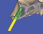 If a realistic simulated implant were to be placed into this site, only a small portion of the implant would be embedded in the bone, leaving too many exposed threads, and lack of fixation.