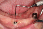 Fig. 2. Healing abutments were removed, and tissue depths recorded using a periodontal probe.