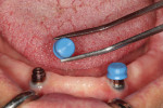 Fig. 4. Scan housings (LOCATOR R-Tx Scan Body, Zest Dental Solutions) were placed onto each abutment.