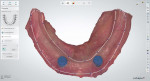 Fig. 7. The optical scan was imported and the borders refined using software algorithms. An outline was drawn to establish borders for the denture based upon clinically obtained physiological measurements.