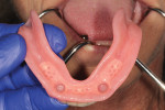 Fig. 18. The prosthesis was placed onto the edentulous ridge with the housings, and passive fit of the prosthesis was confirmed.