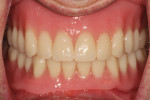 Fig. 22. The patient was pleased with the final esthetic and functional result.