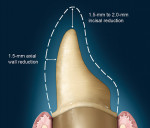 Figure 7  This diagram demonstrates the preparation requirements for an anterior tooth.