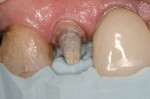 Figure 8  A silicone index in place allows the clinician to verify the amount of incisal reduction.