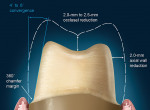 Figure 9  This diagram illustrates the preparation requirements for a posterior tooth.