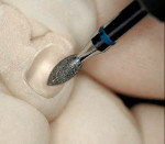 Figure 13  A slow-speed diamond cutting instrument is used to adjust the zirconia framework.