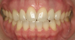 Figure 18  Frontal view of patient’s dentition in MIP after treatment.