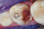 Figure 1b  After removal of silver amalgam and resin material.