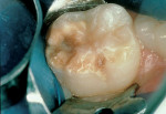 Figure 2a  Enamel hypoplasia/caries lesion of a permanent first molar.