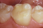 Figure 2c  Vitremer repair 9 years after treatment.