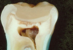 Figure 3  Resin-modified glass-ionomer base, with bonded overlying resin-based composite enamel replacement.