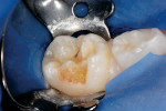 Figure 5a  Large enamel hypoplasia/caries lesion of a primary second molar.
