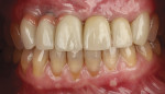 Fig 6. Final outcome at delivery of screw-retained milled ceramic crown restorations.