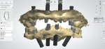 Fig 10. Maxillary and mandibular STL files of presurgical scans with proposed implant positions embedded into the files in design software, enabling design and milling of the provisional prostheses.