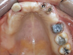 Fig 1. Initial occlusal view of maxillary arch.