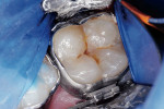 Figure 7a  Occlusal caries in a banded molar.