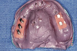 Fig 9. Impression with soft-tissue material for final provisional prosthesis.