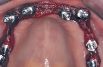 Fig 13. Maxillary arch with impression copings splinted for final impression.