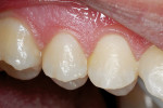 Figure 8a  Teenager with proximal slot restorations46 using nano-ionomer material.